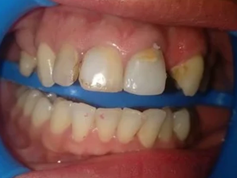 Vue frontale de la dentition avant traitement