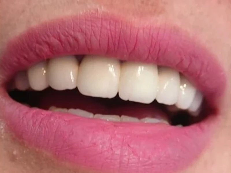 Sourire après traitement