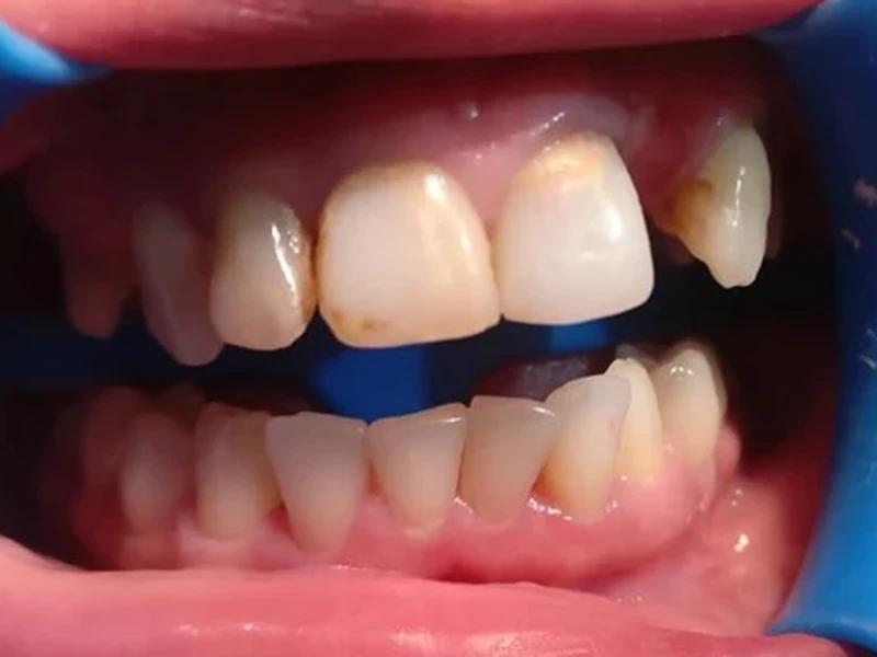 Sourire avant traitement